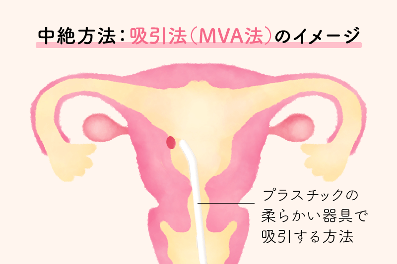 中絶方法：吸引法（MVA法）のイメージ