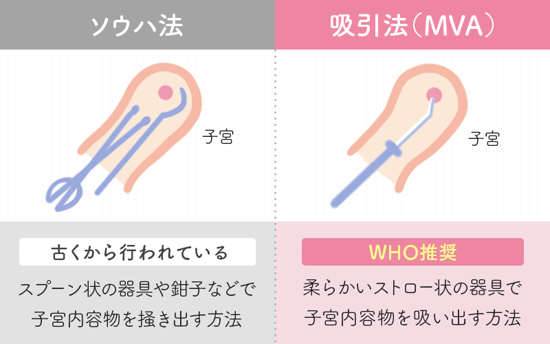 妊娠初期の手術方法（EVAとMVA）
