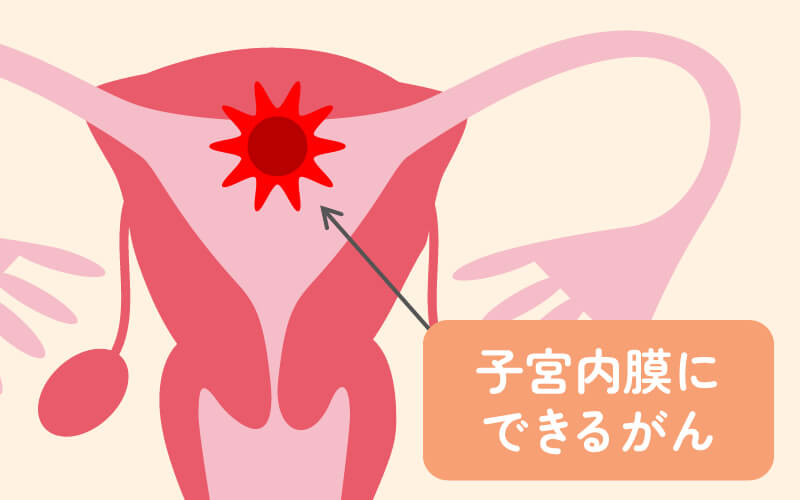 子宮体がんの発生場所