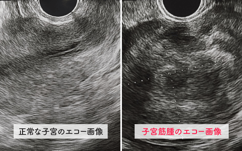 正常な子宮と、子宮筋腫のエコー画像
