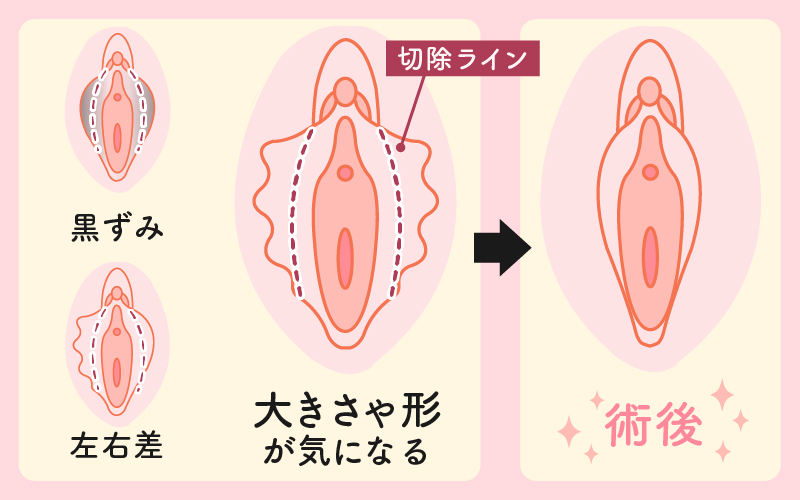 産婦人科専門医が執刀。小陰唇縮小術とは？