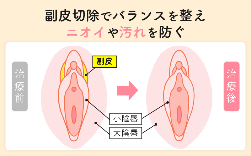 副皮切除術でバランスを整え、においや汚れを防ぐ